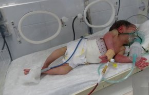 جنایات پنهان سعودیها؛ ناهنجاری های مادرزادی کودکان یمنی