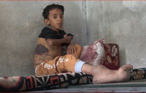 طفل يمني وعبر قناة العالم ينشد الضمير العالمي لحالته المستعصية ويأمل بالعلاج