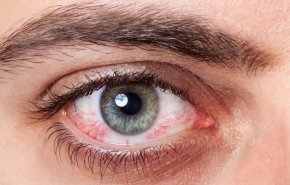 تعرف على أسباب التهاب العيون في الربيع