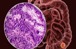 ما هي الأسباب الخفية التي تؤدي إلى إصابة الشباب بسرطان القولون؟