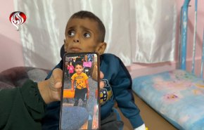 سوء التغذية الحاد يهدد حياة عشرات آلاف الأطفال في غزة
