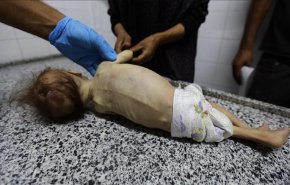 جوع وتشوهات: الأونروا تكشف كابوساً صحياً يضرب غزة بصمت