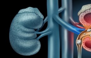 أطعمة تمنع تكون الحصى في الكلى