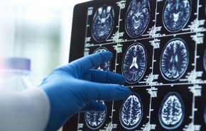 نوع من التوابل الشائعة يسهم في علاج ألزهايمر