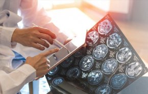 دراسة: بروتين يقلل خطر إصابة الناجين من السرطان بالخرف