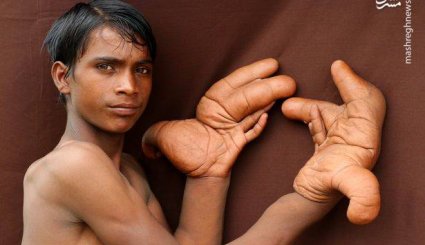 انگشتان غول پیکر یک هندی