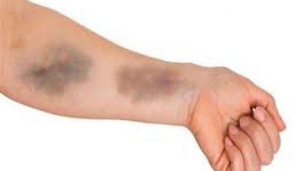 ما أسباب ظهور بقع زرقاء على الجسم؟!

