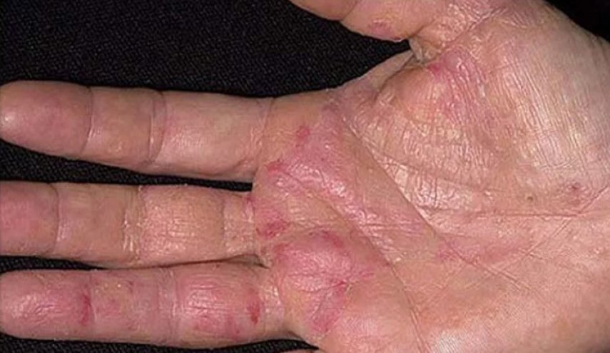 العوارض الأولى للسرطان تظهر على اليدين! كيف تكتشفونها؟