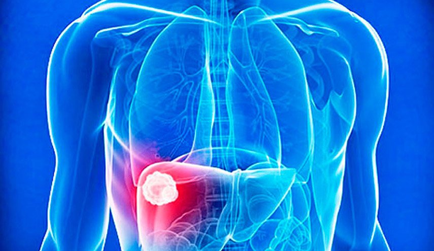 دراسة: العلاج الإشعاعي خيار فعال لمرضى سرطان الكبد