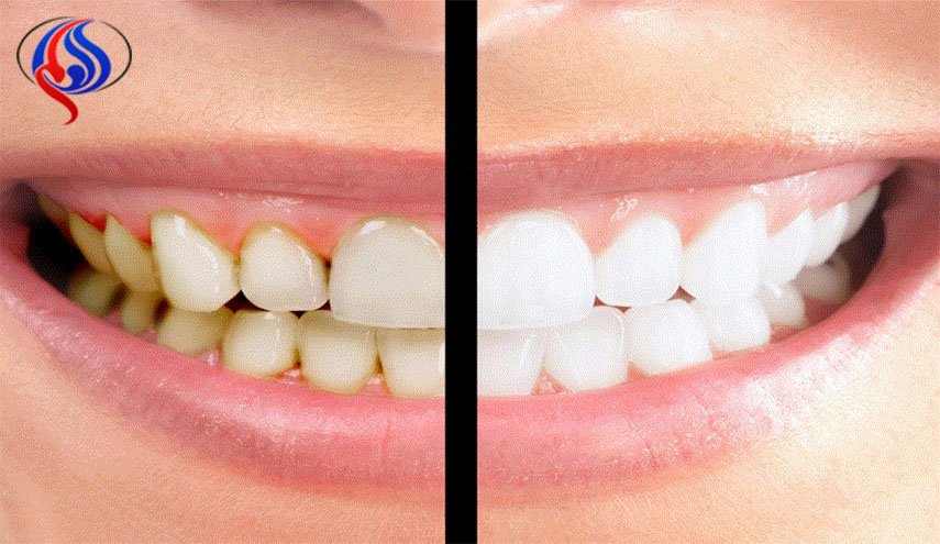 اكتشاف مادة بمفعول سحري لتبييض الاسنان بصورة آمنة 