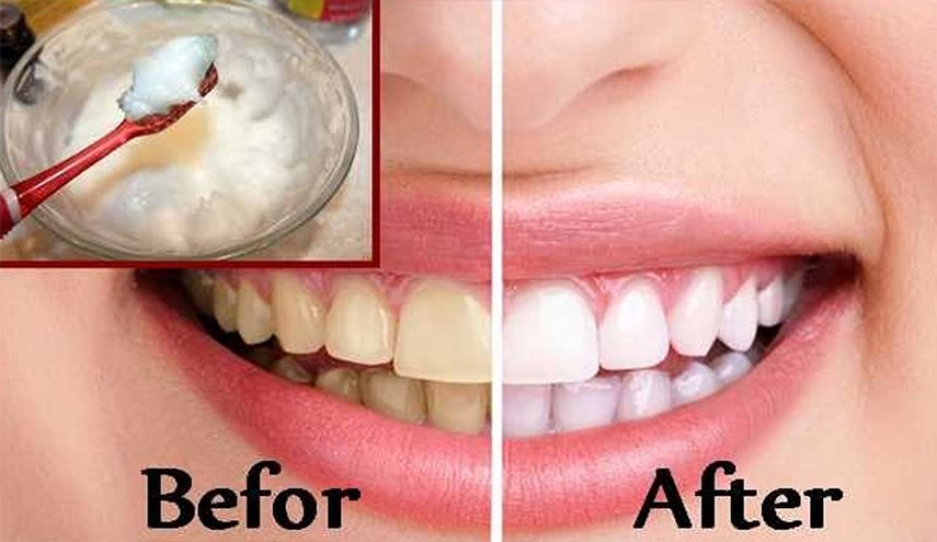 طرق منزلية لازالة الجير من الاسنان
