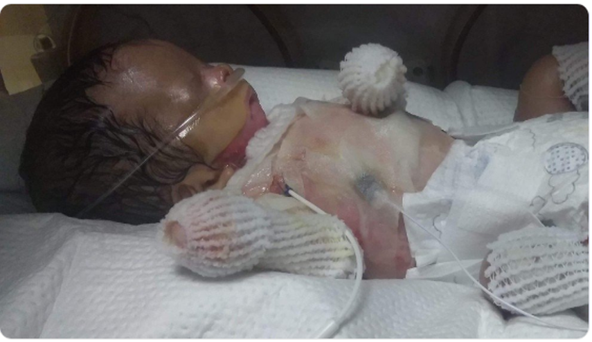 شاهد: حالة طبية نادرة .. طفل يولد دون جلد يغطي جسمه!