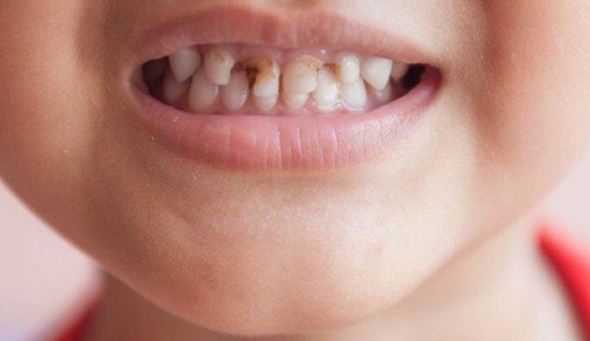 هذه هي حقيقة الرابط بين الجينات وتسوس أسنان الأطفال