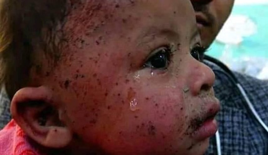 'حلیمه' نوزاد 9 ماهه؛ نماد جدید قربانیان عربستان سعودی در یمن + عکس