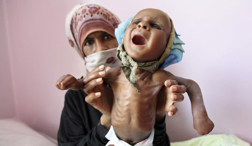 أطفال اليمن سيعانون آثار الجوع لـ20 عاما