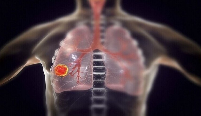 علامة تحذيرية قد تكشف الإصابة بسرطان الرئة