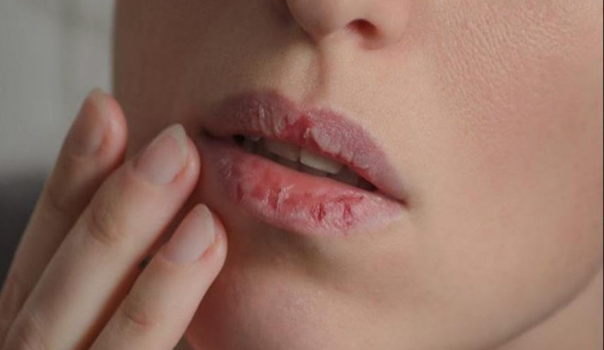 تشقق زوايا الفم مؤشر على الإصابة بالفطريات