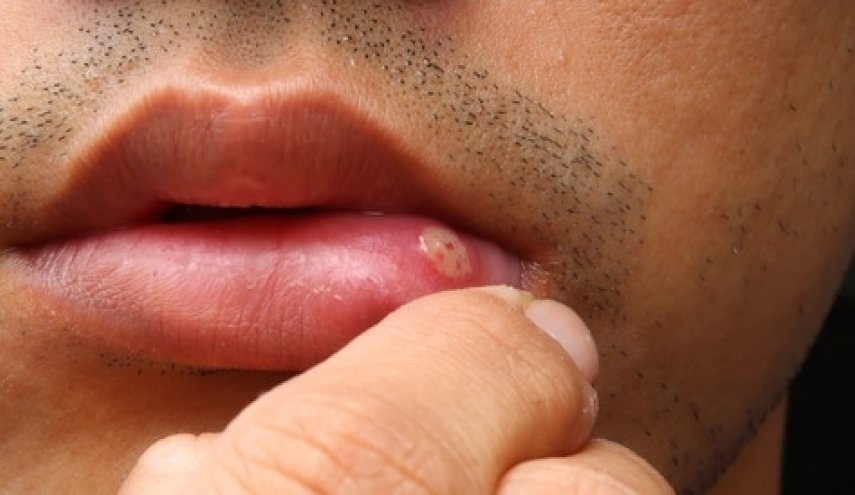 أعراض تشير إلى الإصابة بسرطان الفم