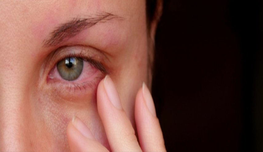 العيون الملتهبة من بين أهم أعراض 'كوفيد-19'