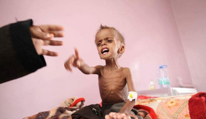 أرقام كارثية: 400 ألف طفل يمني يعانون من سوء التغذية الحاد 