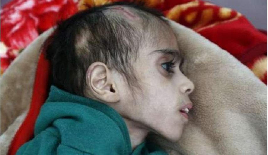 صور صادمة لطفل يمني عمره 7 سنوات ووزنه 7كغم