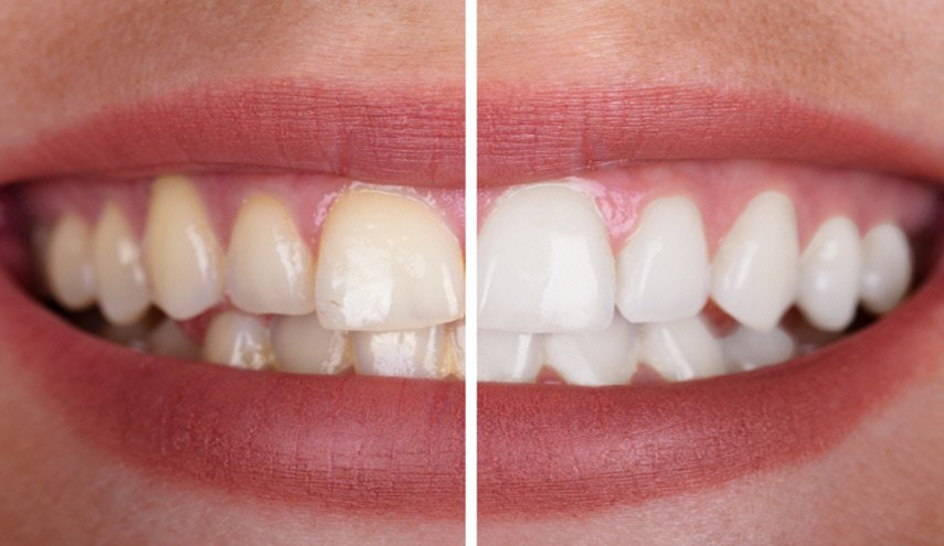 ما هي اسباب وطرق علاج اصفرار الاسنان المختلفة؟