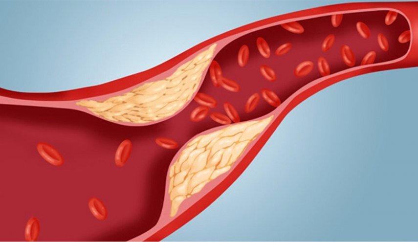 علامات تكشف عن ارتفاع نسبة الكوليسترول في الدم
