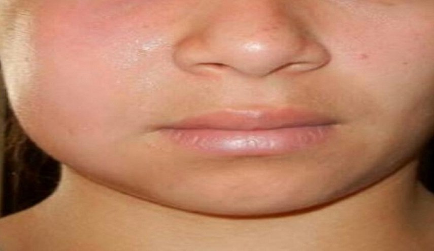 تشخيص سرطان الجلد من خلال تغييرات الوجه
