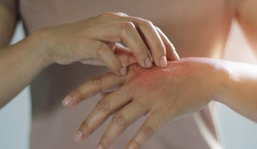 تعرف على 5 علامات وأعراض للإصابة بكورونا تظهر على جلدك 