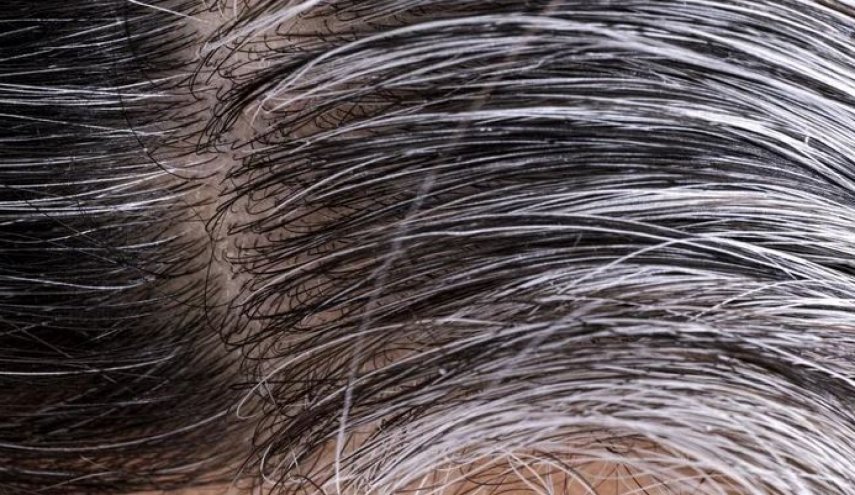 شيب الشعر المبكر أسباب الإصابة وعلاج قناة العالم الاخبارية