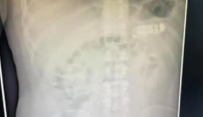 صورة/فريق طبي يصدم بوجود هذا الشيئ الغريب بمعدة رجل ثلاثيني
