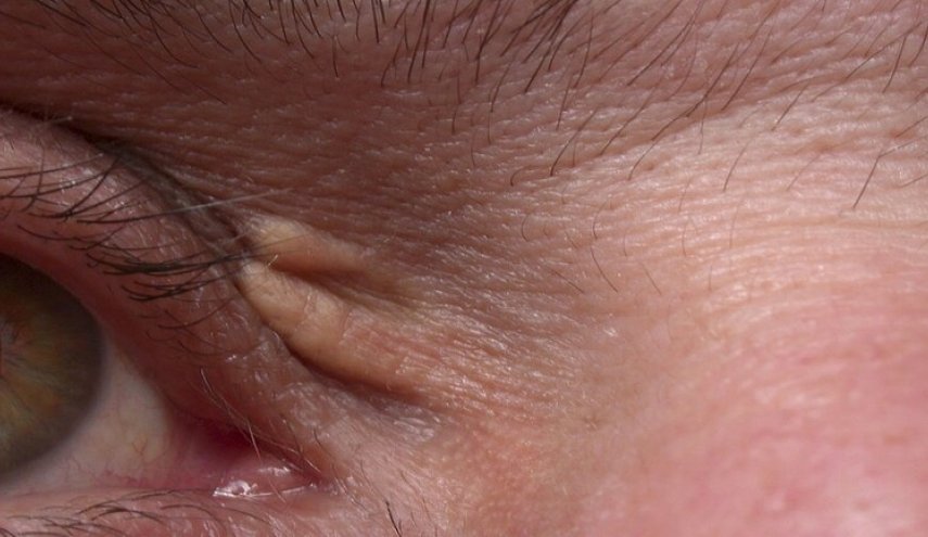 علامة صغيرة على الجلد تكشف عن خطر قد يكون مميتا