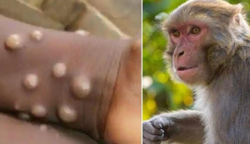 شناسایی اولین مورد ابتلا به «آبله میمون» در امارات