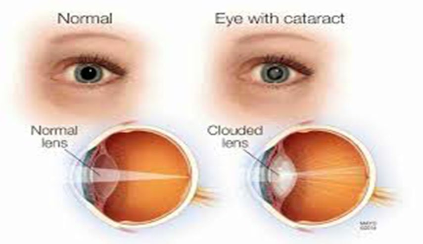 طبيب عيون يوضح كيفية التعرف على إعتام عدسة العين مبكرا
