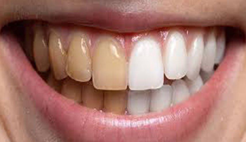 طرق لابتسامة هوليوودية دون تبييض الأسنان