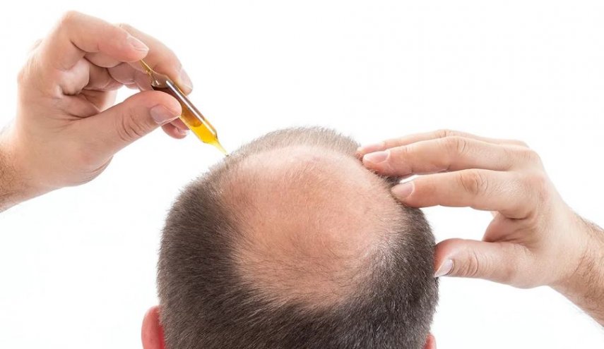 وداعًا للصلع؟ اكتشاف علمي يعيد الأمل لنمو الشعر من جديد