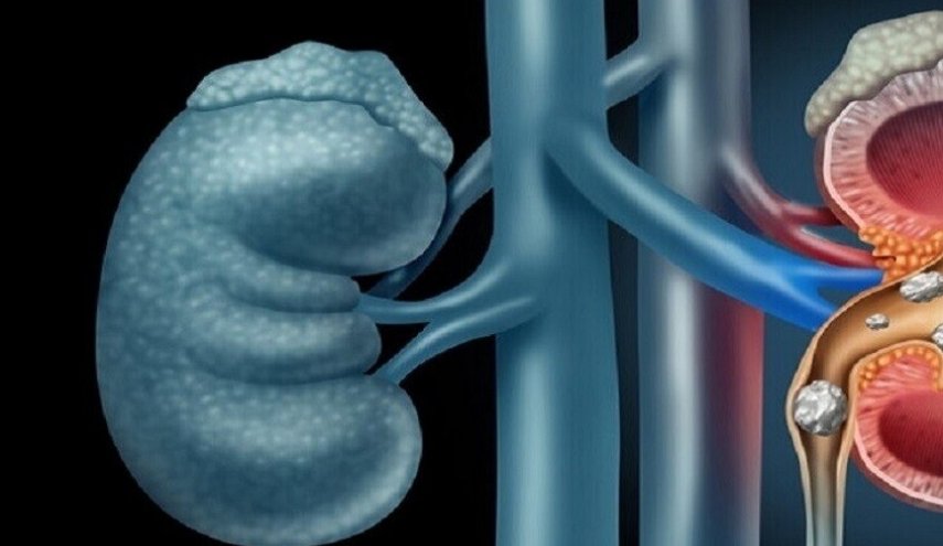 أطعمة تمنع تكون الحصى في الكلى