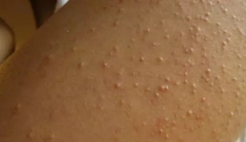 بیماران مبتلا به سلیاک در غزه با مرگ روبرو هستند