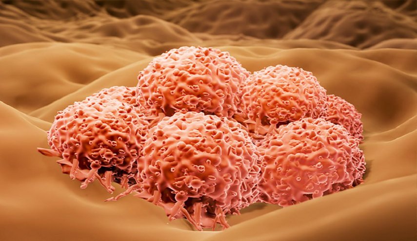 حين ينتقل سرطان الجلد إلى العين… الوجه الخفي للميلانوما؟