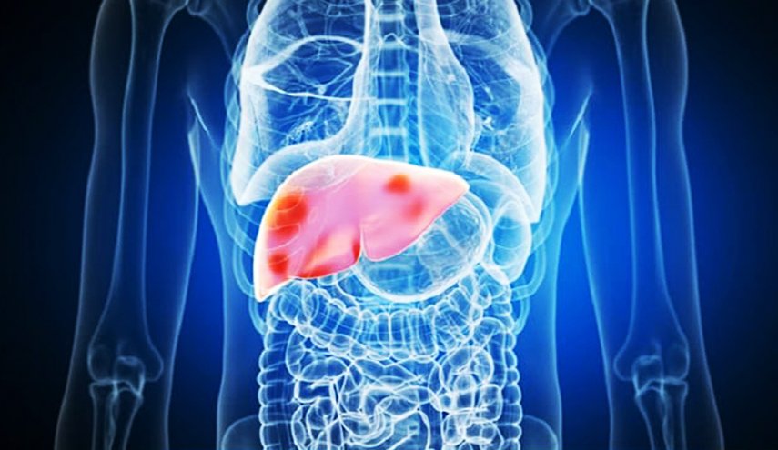 دراسة تكشف العلاقة بين ضمور العضلات والإصابة بتليف الكبد