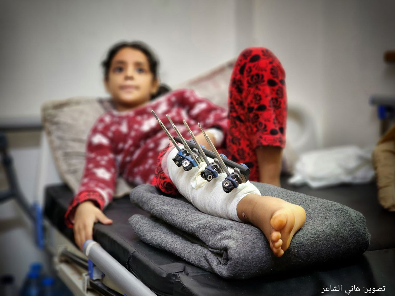 معلولیت های دائم کودکان فلسطینی در نتیجه حملات اشغالگران به غزه + تصاویر 