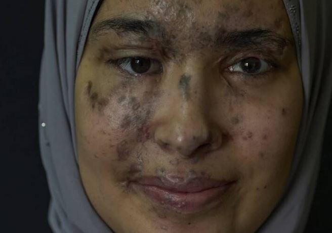 سارا جفال، البالغة من العمر 21 عامًا، أصيبت في هجوم البيجر الذي شنته إسرائيل في 17 سبتمبر 2024.